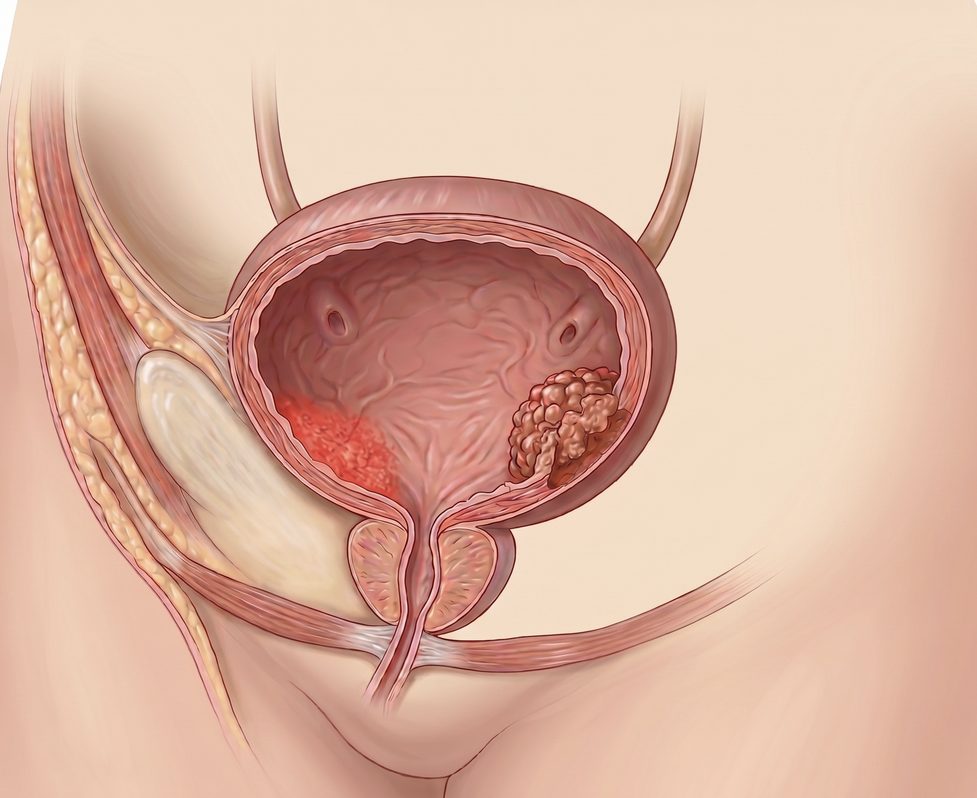 Cirugía vesical robótica