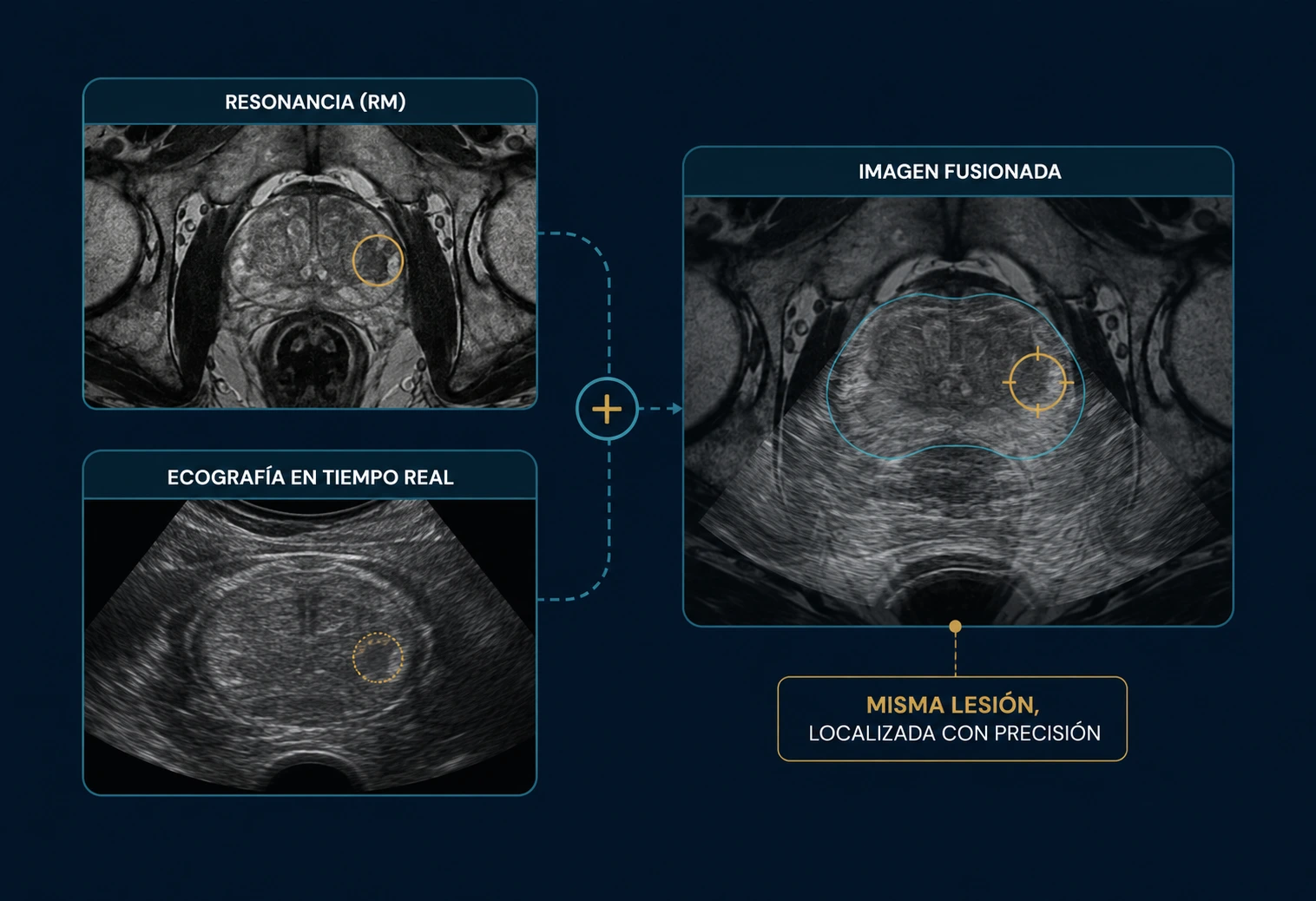 Comparación entre resonancia, ecografía e imagen fusionada para localizar una lesión prostática
